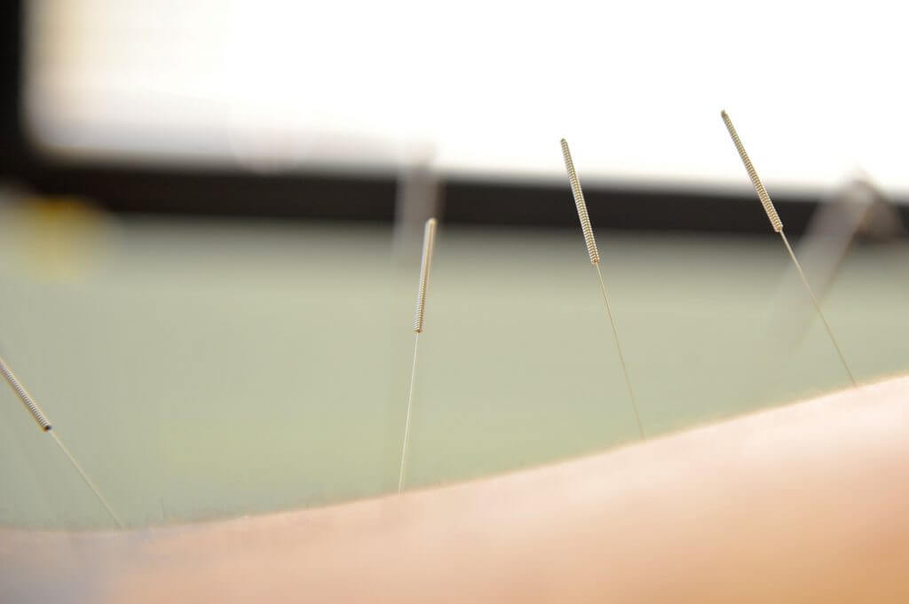 agopuntura e fertilità dettaglio aghi