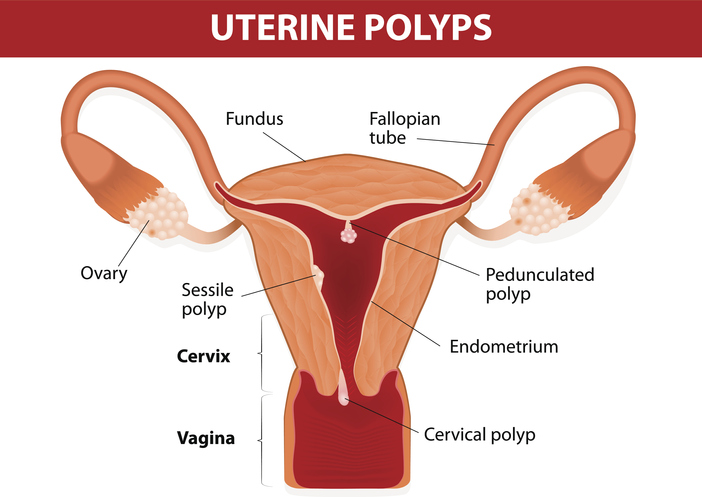 Polipo endometriale e gravidanza