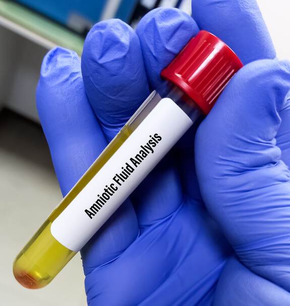 Amniocentesi nuova tecnica con il cariotipo molecolare