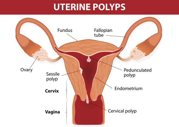 Polipo all’utero si possono avere rapporti?