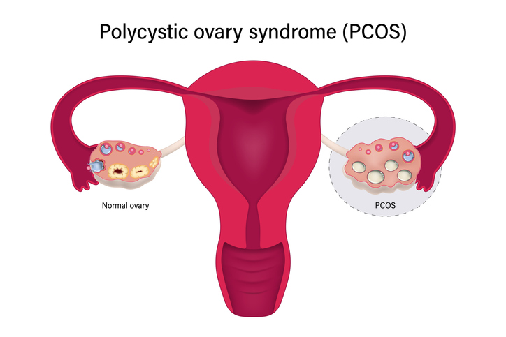 Ovaio policistico: sindrome, sintomi, cura, fertilità e gravidanza