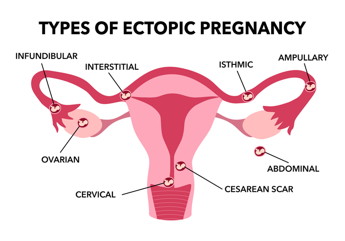 Gravidanza extrauterina o ectopica: cause, sintomi, rischi e fertilità