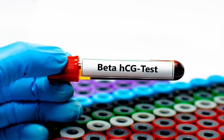 Beta-hcg, valori di riferimento ed interpretazione post transfer