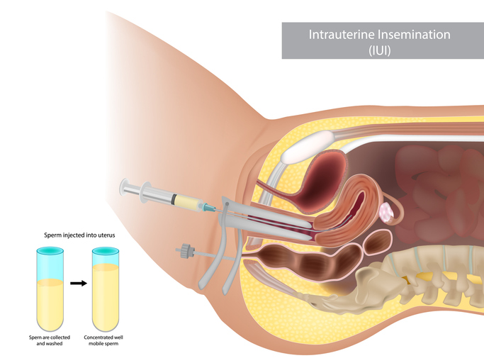 Inseminazione artificiale o primo livello di PMA: tutto quello che c’è da sapere