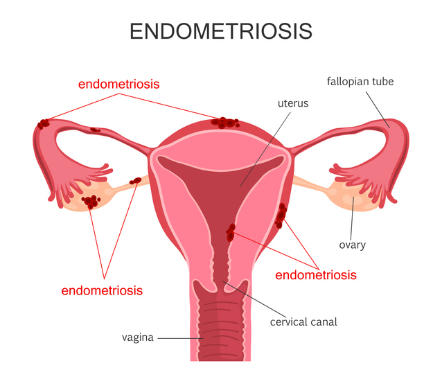 Endometriosi e gravidanza: è possibile con la fecondazione assistita?
