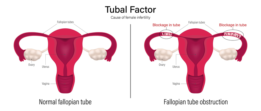 Fattore tubarico infertilità: tutto quello che c’è da sapere